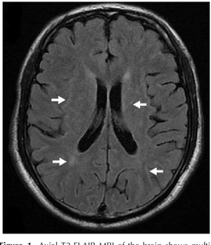 Snail-transmitted rare meningitis ups brain disease risk, shows Indian study