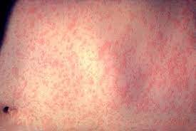 Measles cases triggers alert in Australia