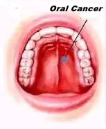 Why India is seeing a rise in oral cancer cases