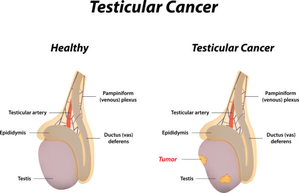 Why young men must be aware of testicular cancer