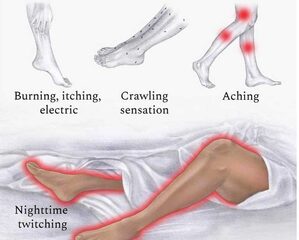 Scientists find treatment for restless leg syndrome