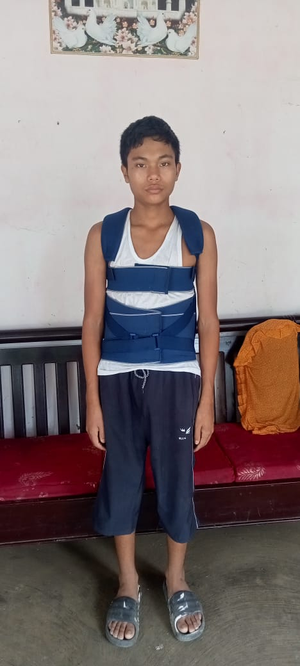 Complex 5-hour-long spine surgery gives Manipur boy a new lease of life