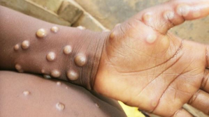 Sweden reports 1st case of more infectious mpox variant outside Africa