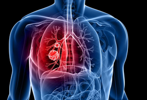 Lung cancer is most common cancer to spread to brain: Experts