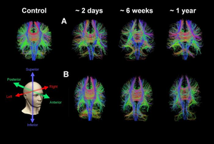 New MRI technique may better predict fatigue, headaches in concussion patients