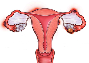 Doctors flag concerns over recurrence of uterine fibroids in young women