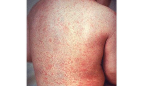 Mongolia reports two additional measles cases